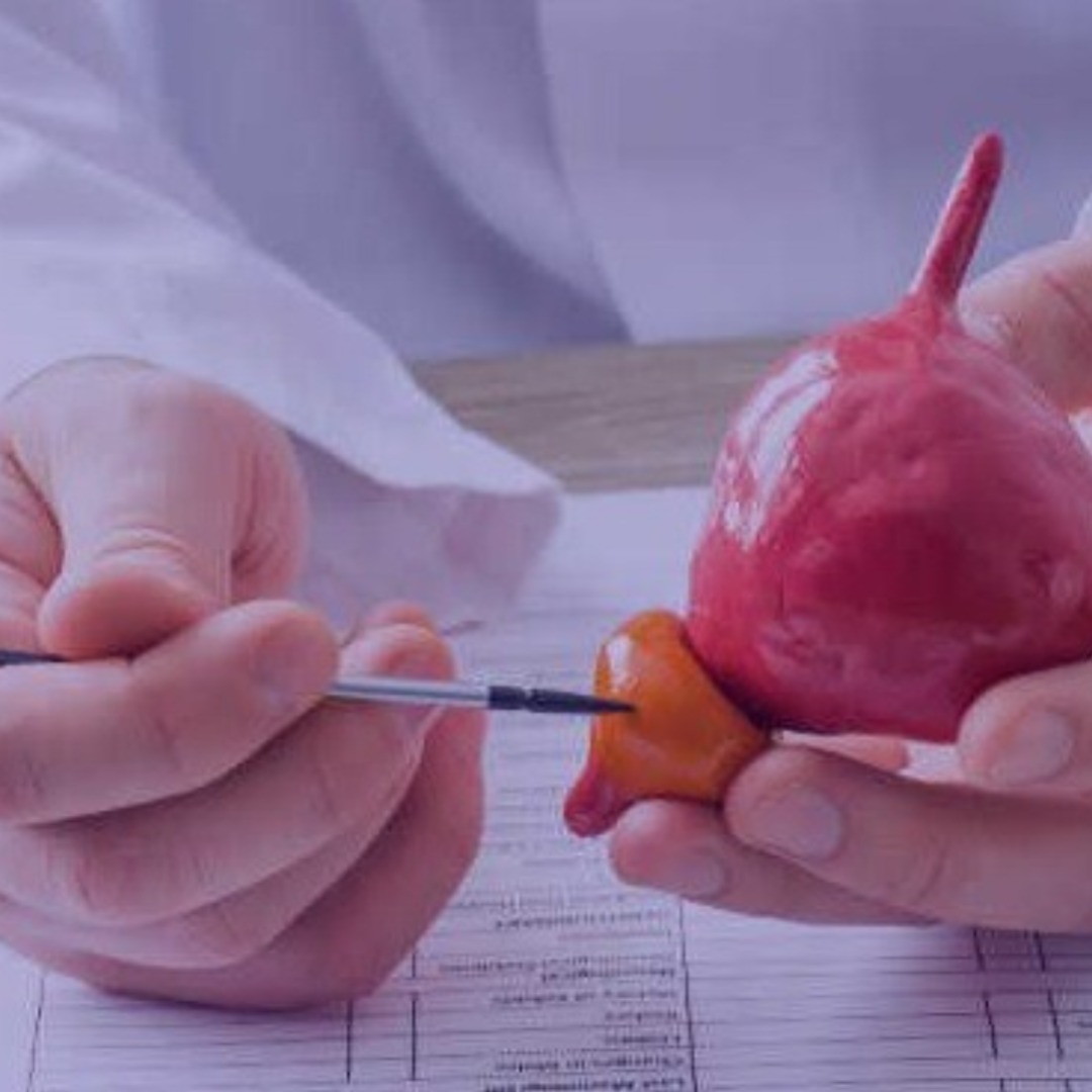 Câncer de próstata: qual o papel do patologista no diagnóstico?