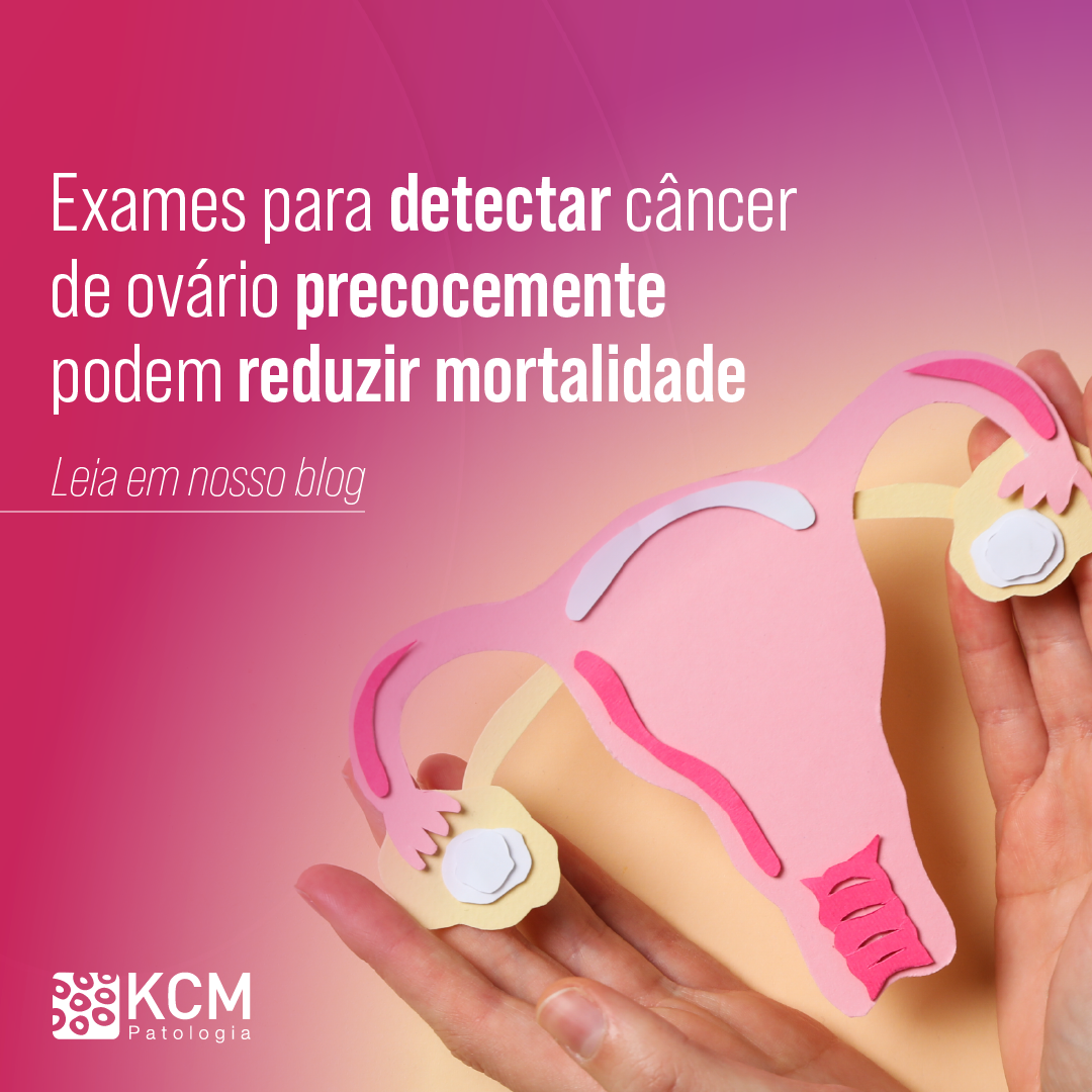 Exames para Detectar Câncer de Ovário Precocemente Podem Reduzir Mortalidade