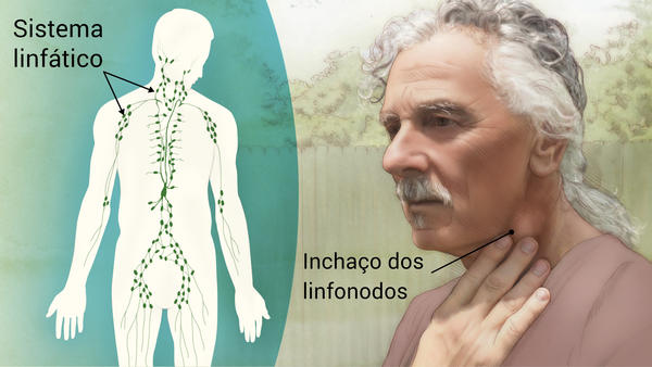 Exame anatomopatológico é essencial para o diagnóstico do linfoma não-Hodgkin